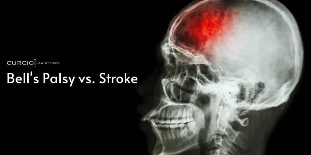 Bell's Palsy vs. Stroke