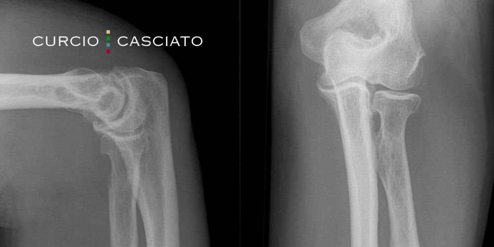 Nursing Home Broken Bone Attorney Chicago